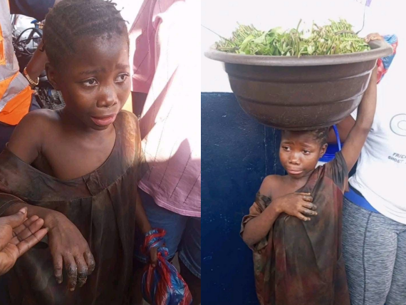 Liberia: Eight- Year-Old Girl Allegedly Burned by Aunt in Shocking Child Abuse Case