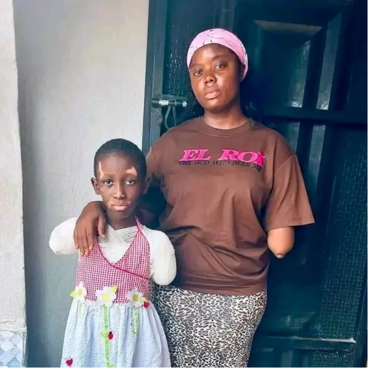 Liberia: Woman Living with a Disability Inspires Girl Who Lost Both Hands to Believe her Future Remains Bright